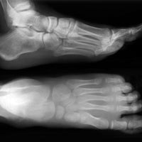Will Vibram Five Fingers or Running Barefoot Injure You?